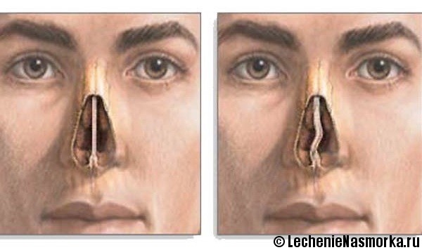 диагностика искривления носовой перегородки